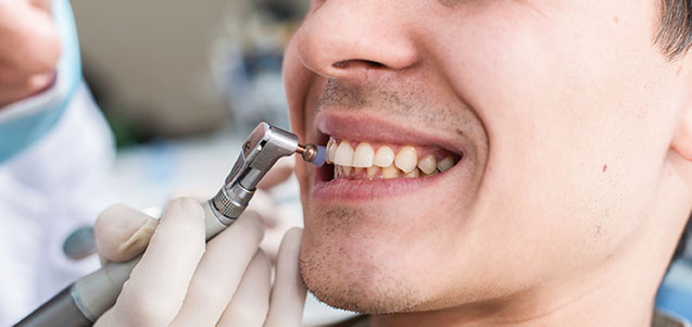 Cada cuánto se recomienda hacer una limpieza dental?