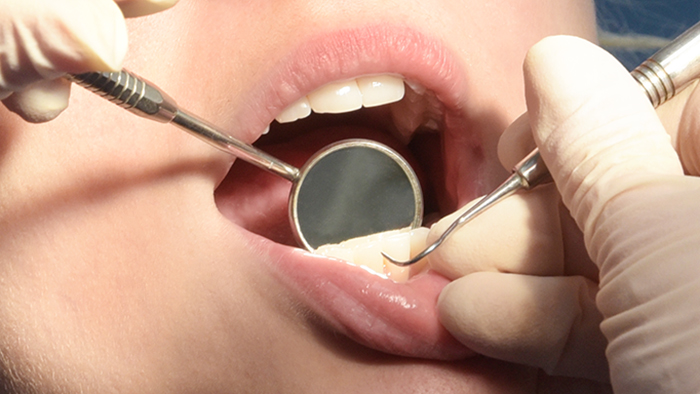 Limpieza Dental básica o profunda ¿Cuál necesito?