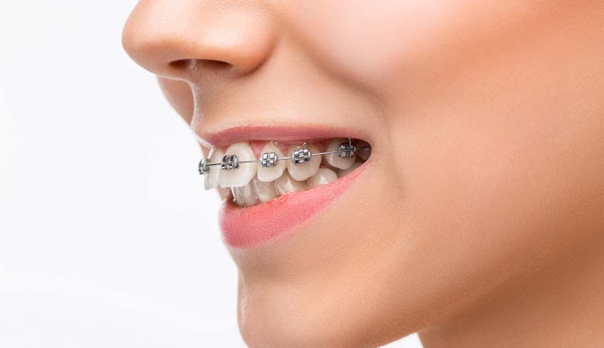 Paciente con brackets metálicos