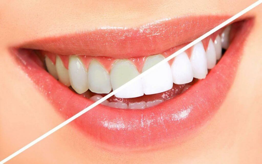 Mejorando Sonrisas: Carillas Dentales frente a Blanqueamiento y Ortodoncia