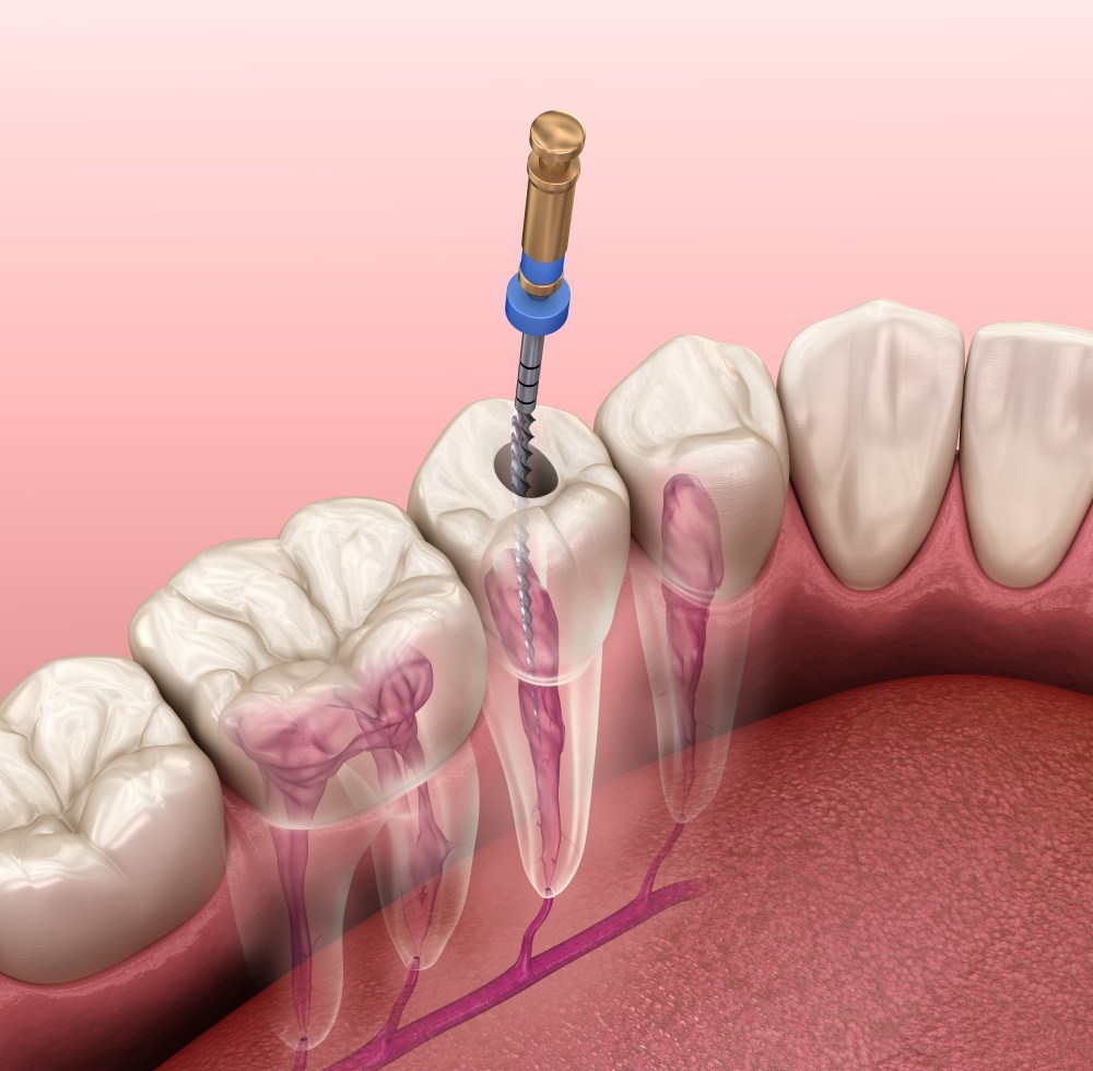 Clínica dental en Guatemala-Servicio de Endodoncia en Adultos