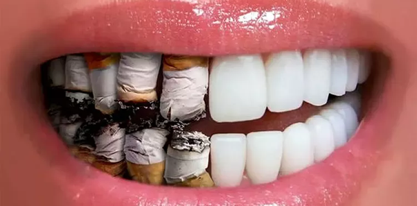 Imagen ilustrativa de los dientes de un fumador