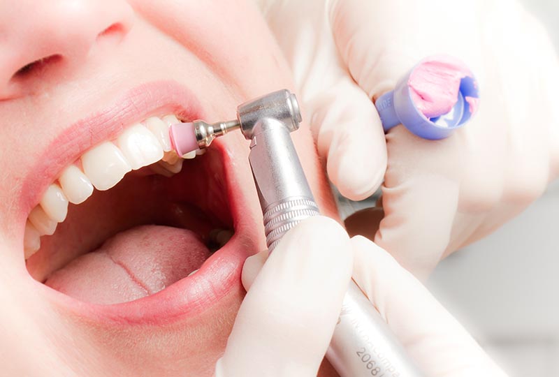 Clínica dental en Guatemala-Limpieza dental profesional