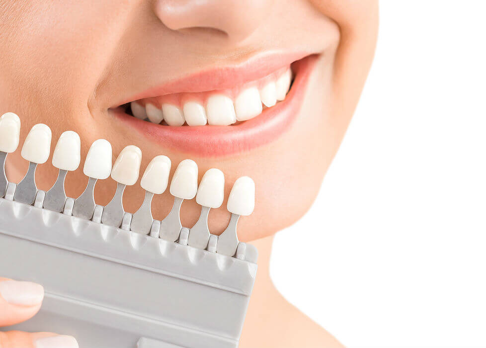 A partir de qué edad se recomienda el uso de carillas dentales?