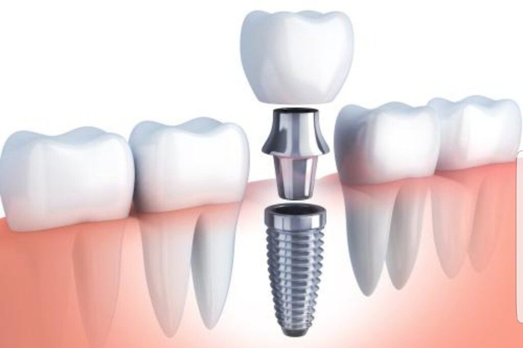 Clínica dental en Guatemala-Prótesis dental fija