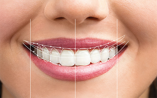 A que se le denomina diseño de sonrisa?