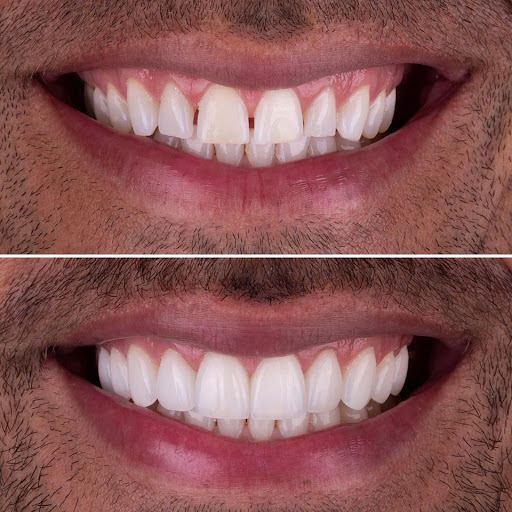 Clínica dental en Guatemala-Carillas Dentales de Porcelana