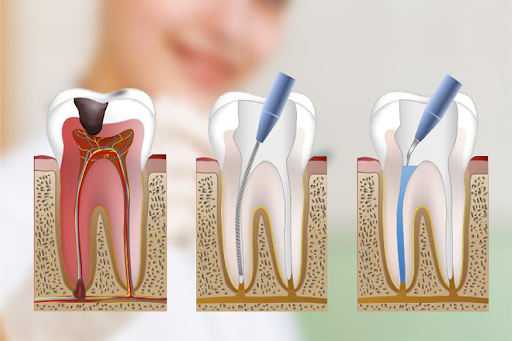 Proceso de una endodoncia