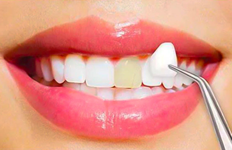 Cuáles son las ventajas de las Carillas Dentales?
