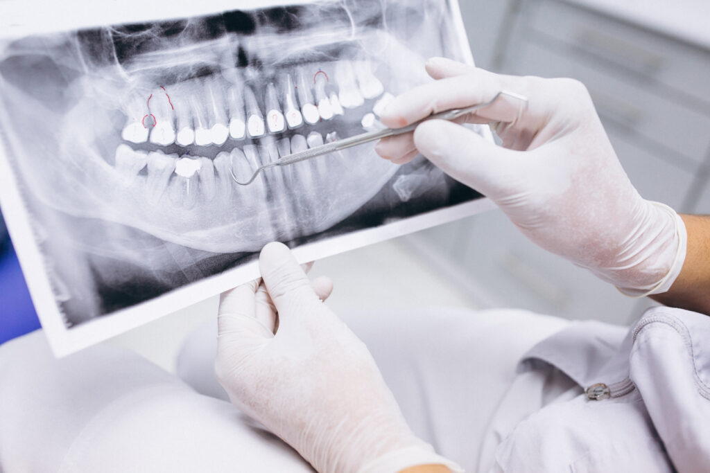 Extracción dental: Cosas a tener en cuenta.