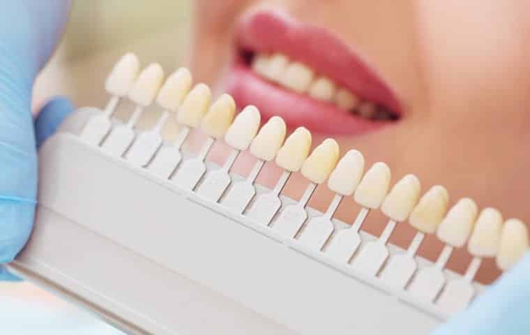 Eligiendo color de Carilla dental