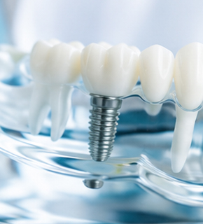 Implantes dentales en Guatemala