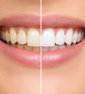 Blanqueamiento dental en Guatemala