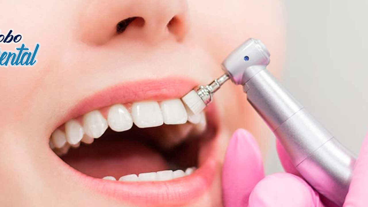 Limpieza Dental | Clínica dental Guatemala