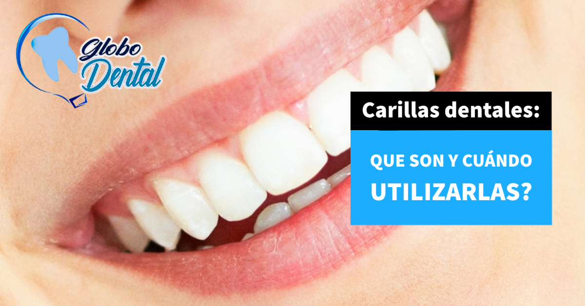Qué son las carillas dentales y para qué sirven - Rojas Villa Odontólogos