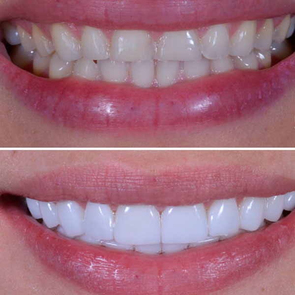 carillas dentales antes y después 
