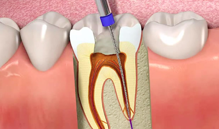 Procedimiento de endodoncia