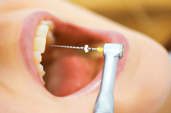 Paciente de endodoncia