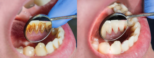 Comparativo con y sin Limpieza dental