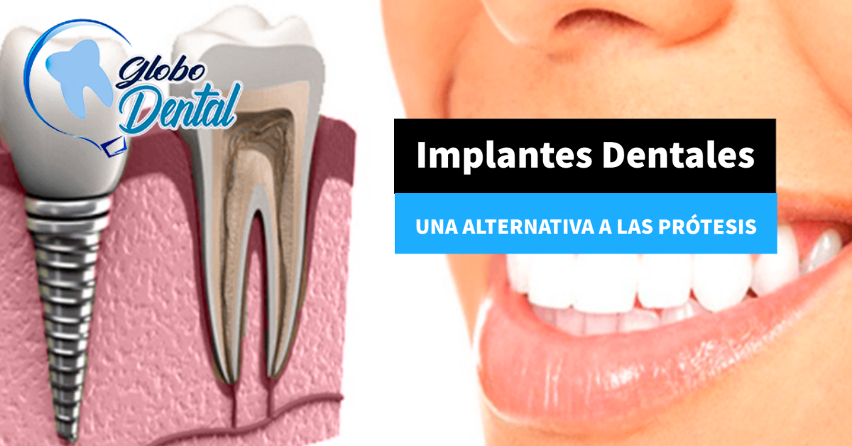 Implantes  Dentales: Una alternativa a las prótesis