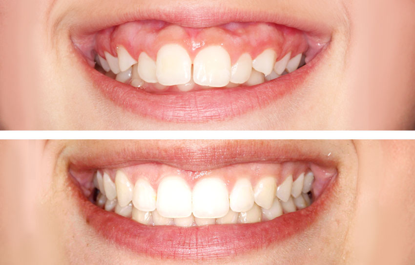 Antes y después paciente con ortodoncia