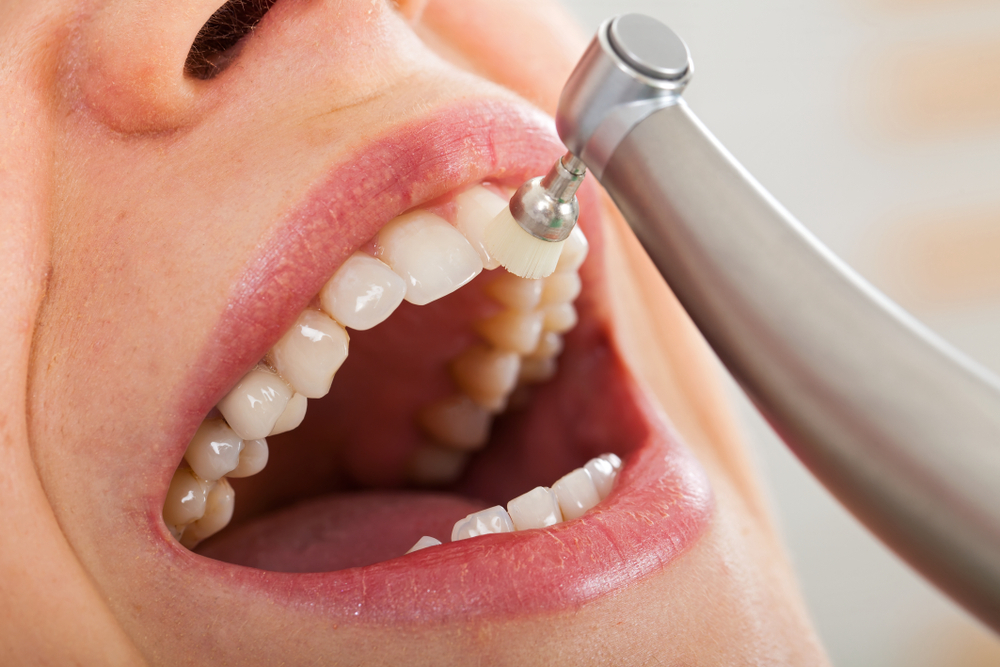 Limpieza dental en clínica dental