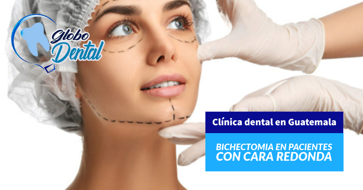 Clínica dental en Guatemala-Bichectomia en pacientes con cara redonda