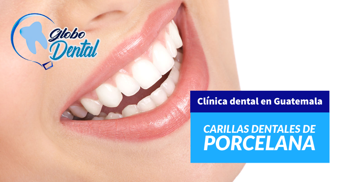 Clínica dental en Guatemala-Carillas Dentales de Porcelana