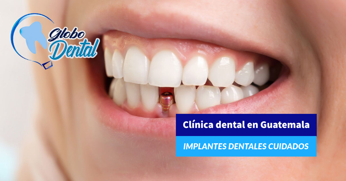 Clínica dental en Guatemala-Implantes dentales cuidados