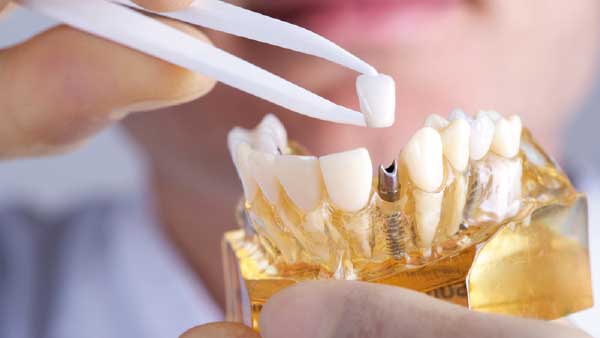 Muestra de implantes dentales