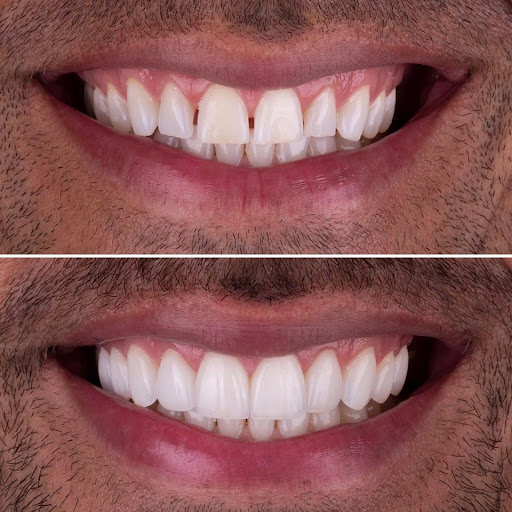 Antes y después con carillas dentales de porcelana