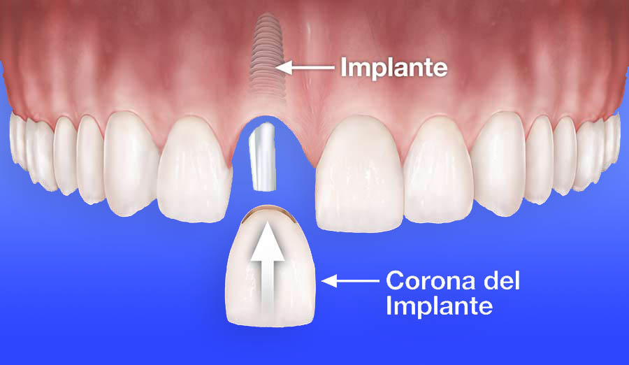 corona implante dental