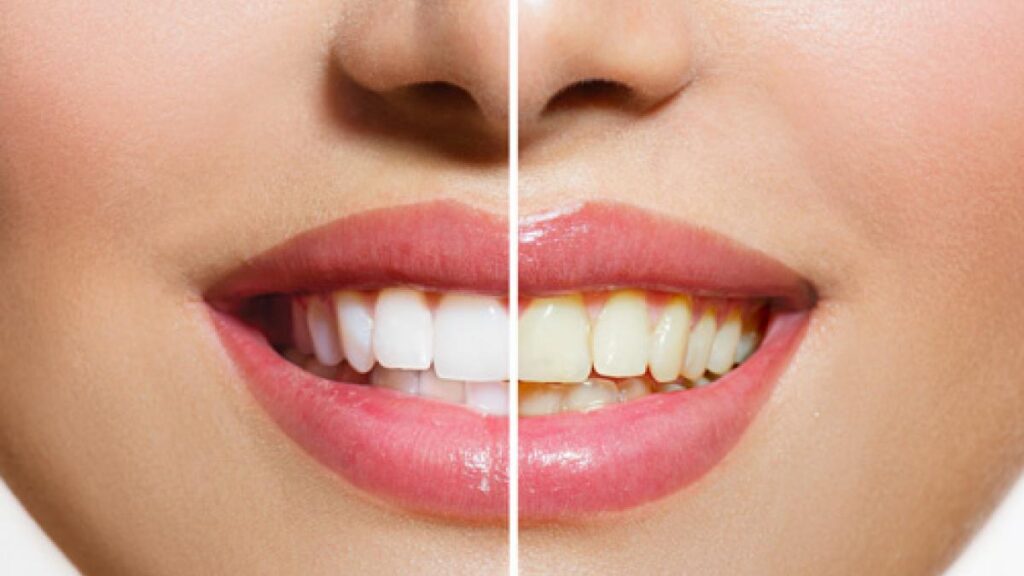 Cambiar o sustituir las carillas dentales
