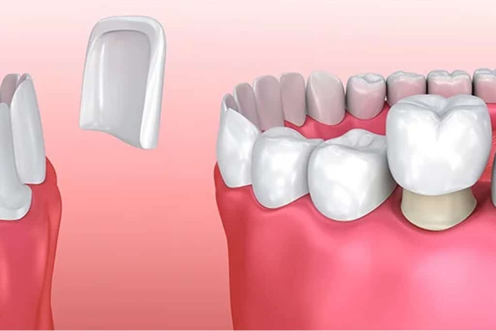 Carillas dentales vs coronas dentales