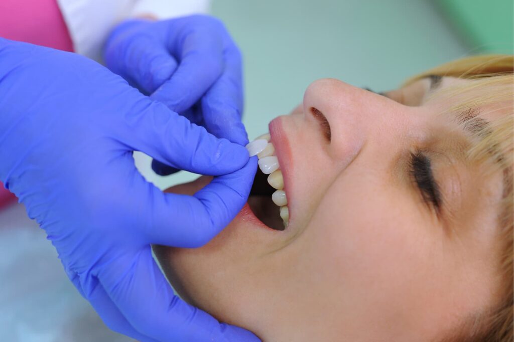 Adherencia de carillas dentales en paciente