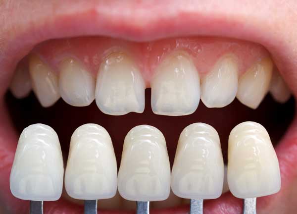 Probador de carillas dentales