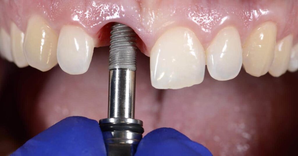 Procedimiento de implantes dentales