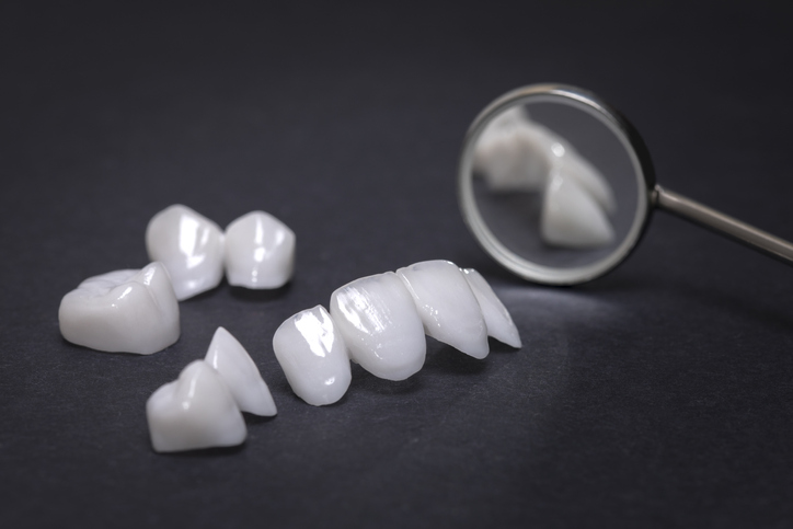 Carillas dentales de composite