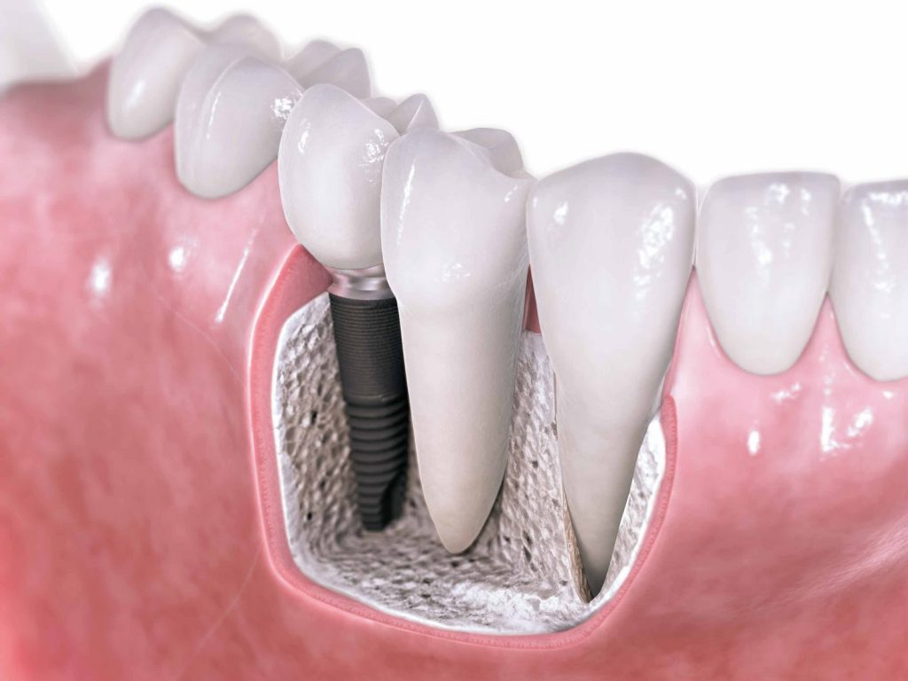 Recreación de implante dental