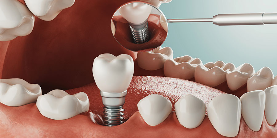 Implantes dentales en casos especiales