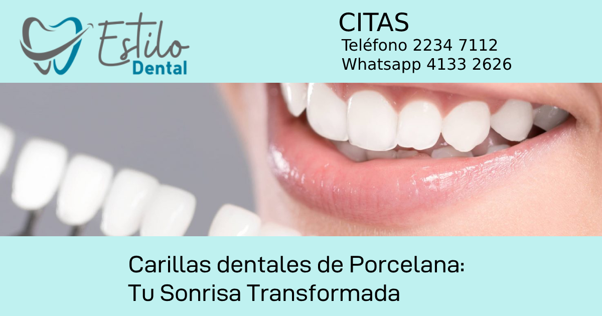 Carillas dentales de Porcelana: Tu Sonrisa Transformada