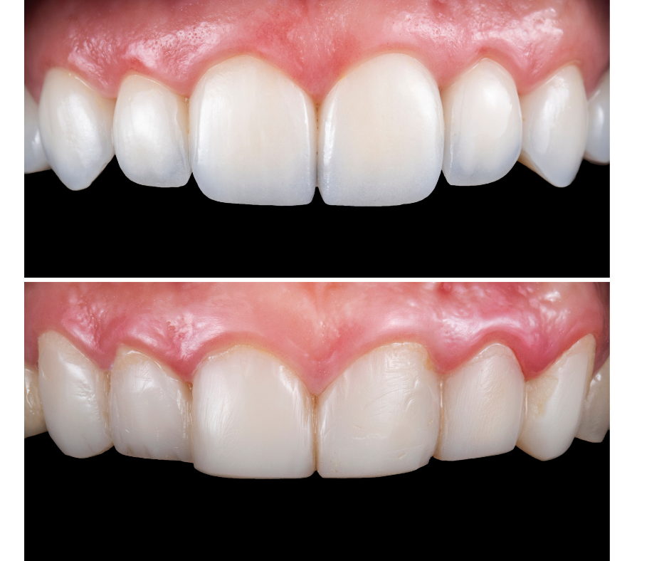 antes y depues carillas dentales