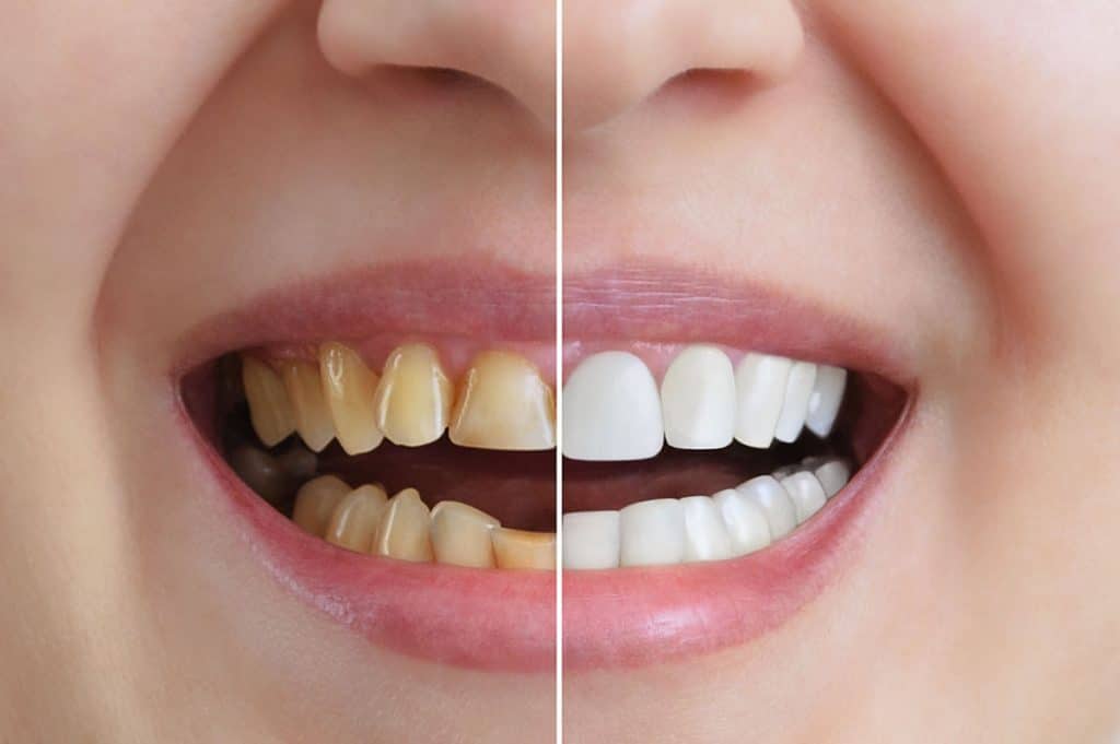 antes y después de las carillas dentales